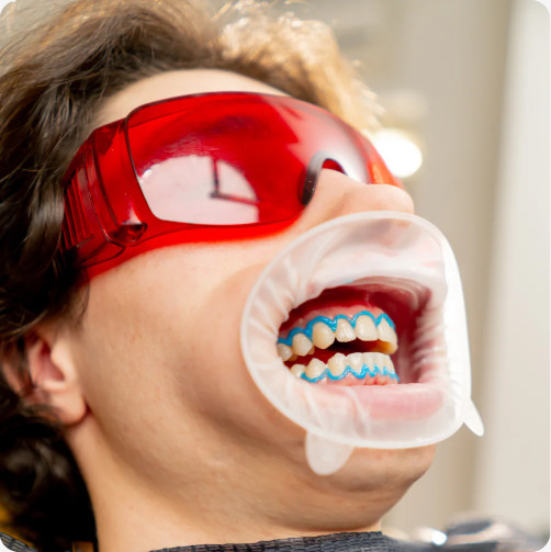 Patient wearing protective glasses during a whitening treatment